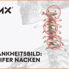 Grafische Darstellung der Halswirbelsäule mit roten Kreisen, die Bereiche markieren, die zu einem steifen Nacken führen können.