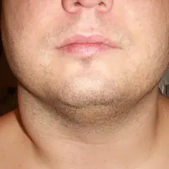 Nahaufnahme eines Halses mit einer seitlichen Schwellung am Hals ohne Schmerzen.