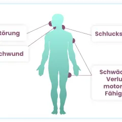 Menschliche Silhouette mit Markierungen für Sprachstörung, Zungenschwund, Schluckstörungen und Schwäche/Verlust motorischer Fähigkeiten als Symptome.