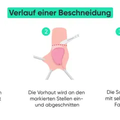 Verlauf einer Beschneidung Mann: Markierung, Schnitt der Vorhaut und Vernähung. Vorher-nachher-Darstellung des Eingriffs.