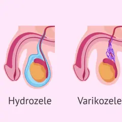 Illustrationen zeigen verschiedene Zustände des Hodens: Kryptorchismus, Hydrozele, Varikozele und Orchitis. Bei manchen Zuständen kann der hoden kleiner geworden sein.