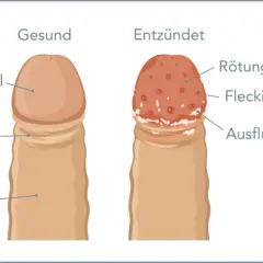 Vergleich: gesunde Eichel vs. entzündete Eichel mit Rötung, Ausschlag und Ausfluss. Bei juckender Eichel können Hausmittel helfen.