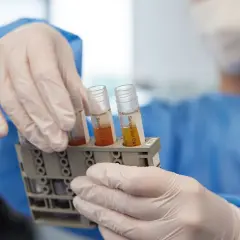 Laborant hält Röhrchen mit Serum. Blutbild kann bei Darmkrebs Anzeichen aufzeigen.