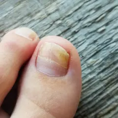 Zeigt einen Zeh mit Nagelpilz. Suche nach nagelpilz hausmittel zur Behandlung.