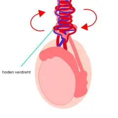 Illustration zeigt einen verdrehten Hoden, der einen Knoten am Hodensack bildet. Rote Pfeile deuten die Drehrichtung an.
