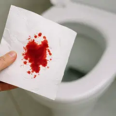 Blut am Toilettenpapier, aber nicht im Stuhl. Eine Hand hält ein Stück weißes Papier mit roten Blutflecken vor einer unscharfen Toilette.