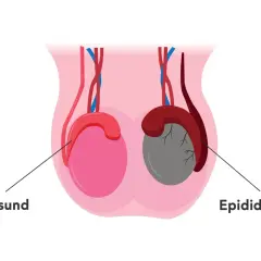 Ein Mann hat zwei Hoden. Dieses Bild zeigt einen gesunden Hoden (rosa) und einen mit Epididymitis (grau).