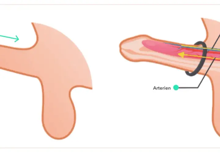 Illustration zeigt, wie ein zu enger penisring den Blutfluss behindert. Arterien werden komprimiert, Venen gestaut.
