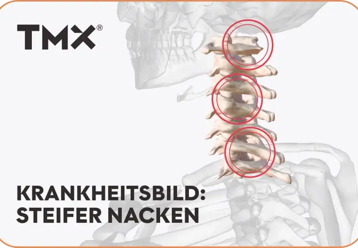 Grafische Darstellung der Halswirbelsäule mit roten Kreisen, die Bereiche markieren, die zu einem steifen Nacken führen können.