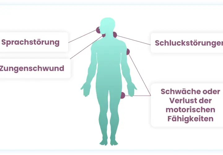 Menschliche Silhouette mit Markierungen für Sprachstörung, Zungenschwund, Schluckstörungen und Schwäche/Verlust motorischer Fähigkeiten als Symptome.
