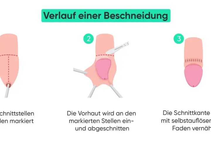Verlauf einer Beschneidung Mann: Markierung, Schnitt der Vorhaut und Vernähung. Vorher-nachher-Darstellung des Eingriffs.