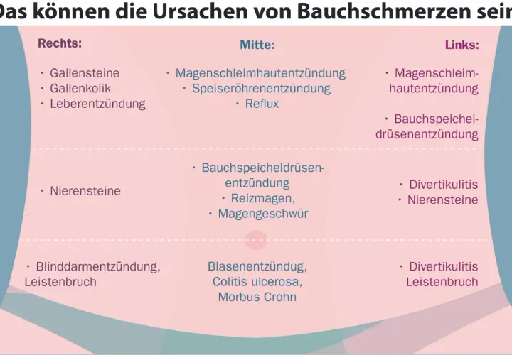 Ursachen für Schmerzen im rechten Unterbauch: Gallensteine, Gallenkolik, Leberentzündung, Nierensteine, Blinddarmentzündung, Leistenbruch.