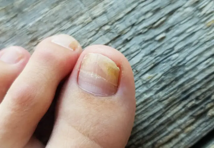 Zeigt einen Zeh mit Nagelpilz. Suche nach nagelpilz hausmittel zur Behandlung.