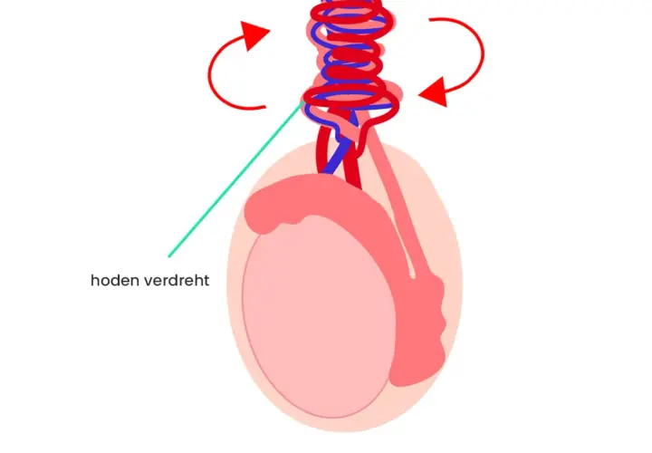 Illustration zeigt einen verdrehten Hoden, der einen Knoten am Hodensack bildet. Rote Pfeile deuten die Drehrichtung an.