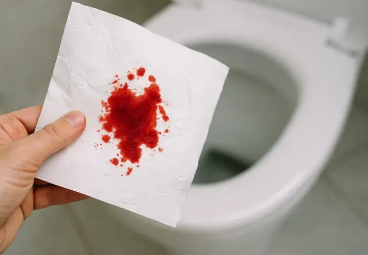 Blut am Toilettenpapier, aber nicht im Stuhl. Eine Hand hält ein Stück weißes Papier mit roten Blutflecken vor einer unscharfen Toilette.