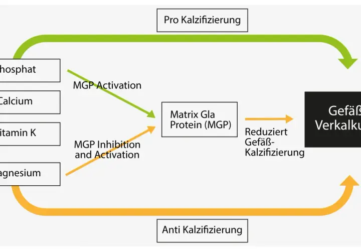 Schema zeigt, wie Vitamin K, Kalzium und Phosphat die Gefäßverkalkung beeinflussen. Vitamin K aktiviert MGP, was Gefäßverkalkung reduziert.