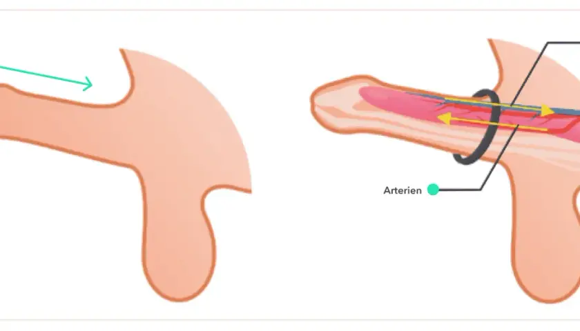 Illustration zeigt, wie ein zu enger penisring den Blutfluss behindert. Arterien werden komprimiert, Venen gestaut.