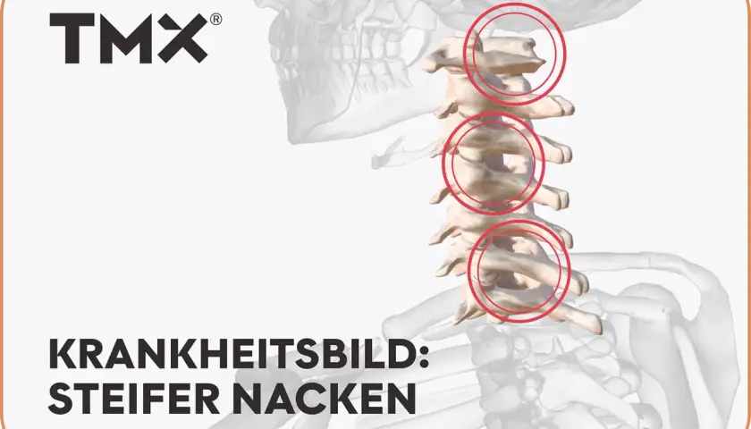 Grafische Darstellung der Halswirbelsäule mit roten Kreisen, die Bereiche markieren, die zu einem steifen Nacken führen können.
