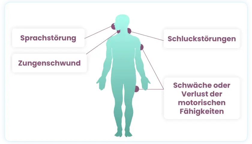 Menschliche Silhouette mit Markierungen für Sprachstörung, Zungenschwund, Schluckstörungen und Schwäche/Verlust motorischer Fähigkeiten als Symptome.