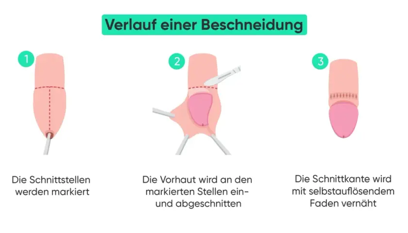 Verlauf einer Beschneidung Mann: Markierung, Schnitt der Vorhaut und Vernähung. Vorher-nachher-Darstellung des Eingriffs.