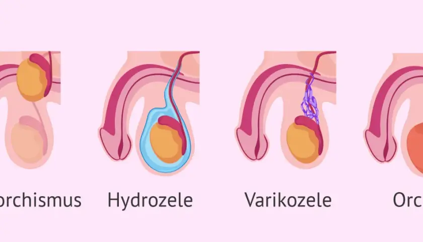 Illustrationen zeigen verschiedene Zustände des Hodens: Kryptorchismus, Hydrozele, Varikozele und Orchitis. Bei manchen Zuständen kann der hoden kleiner geworden sein.