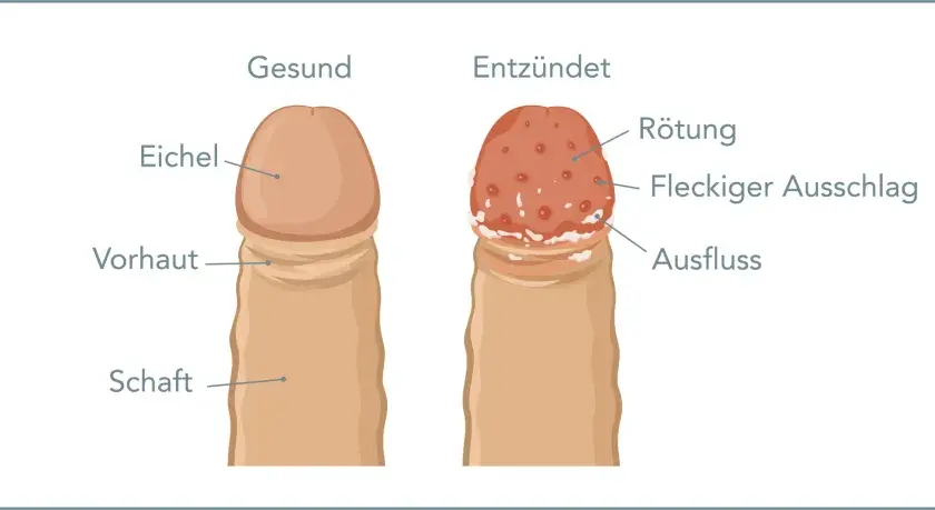 Vergleich: gesunde Eichel vs. entzündete Eichel mit Rötung, Ausschlag und Ausfluss. Bei juckender Eichel können Hausmittel helfen.