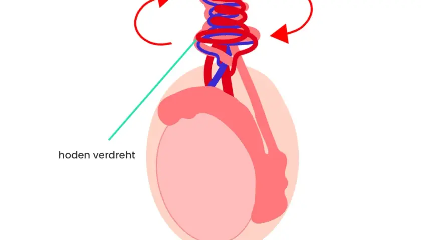Illustration zeigt einen verdrehten Hoden, der einen Knoten am Hodensack bildet. Rote Pfeile deuten die Drehrichtung an.