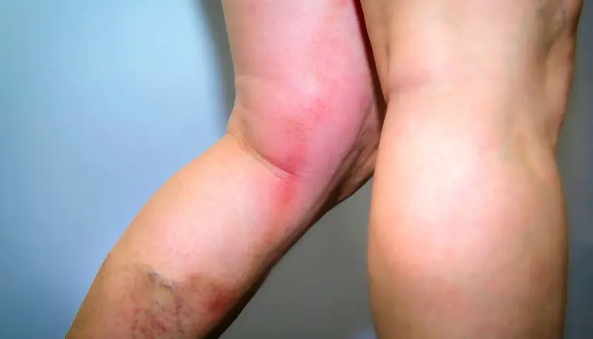 Rotes, geschwollenes Bein mit sichtbaren Krampfadern. Mögliche verstopfte Venen in den Beinen Symptome.