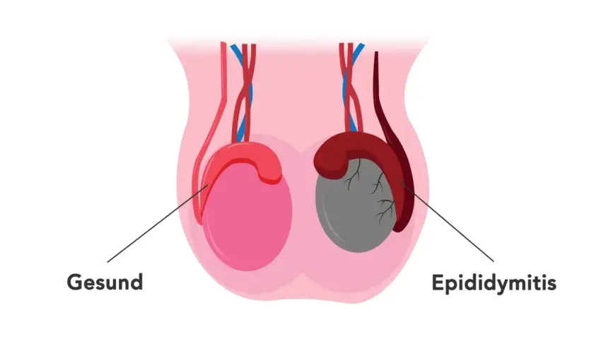 Ein Mann hat zwei Hoden. Dieses Bild zeigt einen gesunden Hoden (rosa) und einen mit Epididymitis (grau).