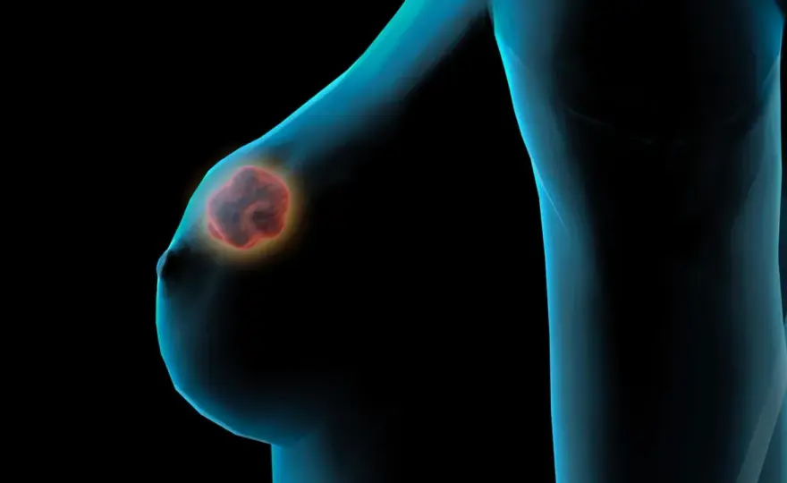 Brustknoten - Harmlos oder gefährlich? Symptome & Abklärung