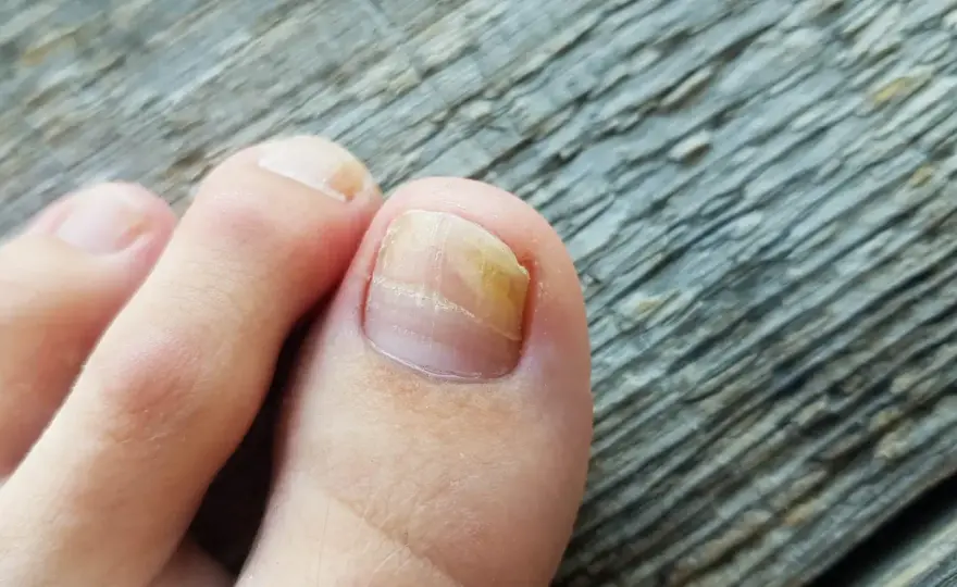Nagelpilz Hausmittel - Was wirklich hilft & wann zum Arzt?