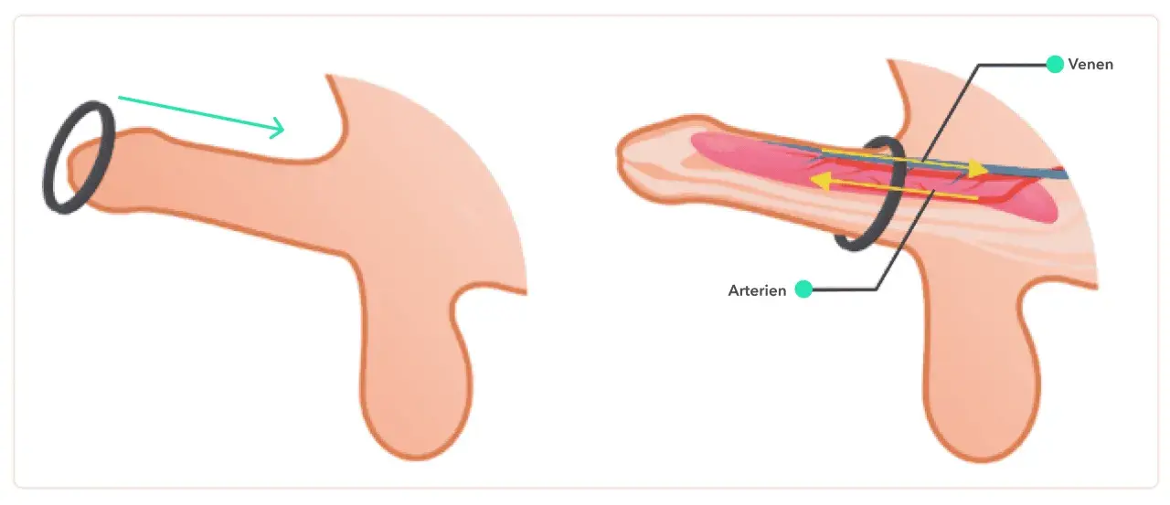 Illustration zeigt, wie ein zu enger penisring den Blutfluss behindert. Arterien werden komprimiert, Venen gestaut.