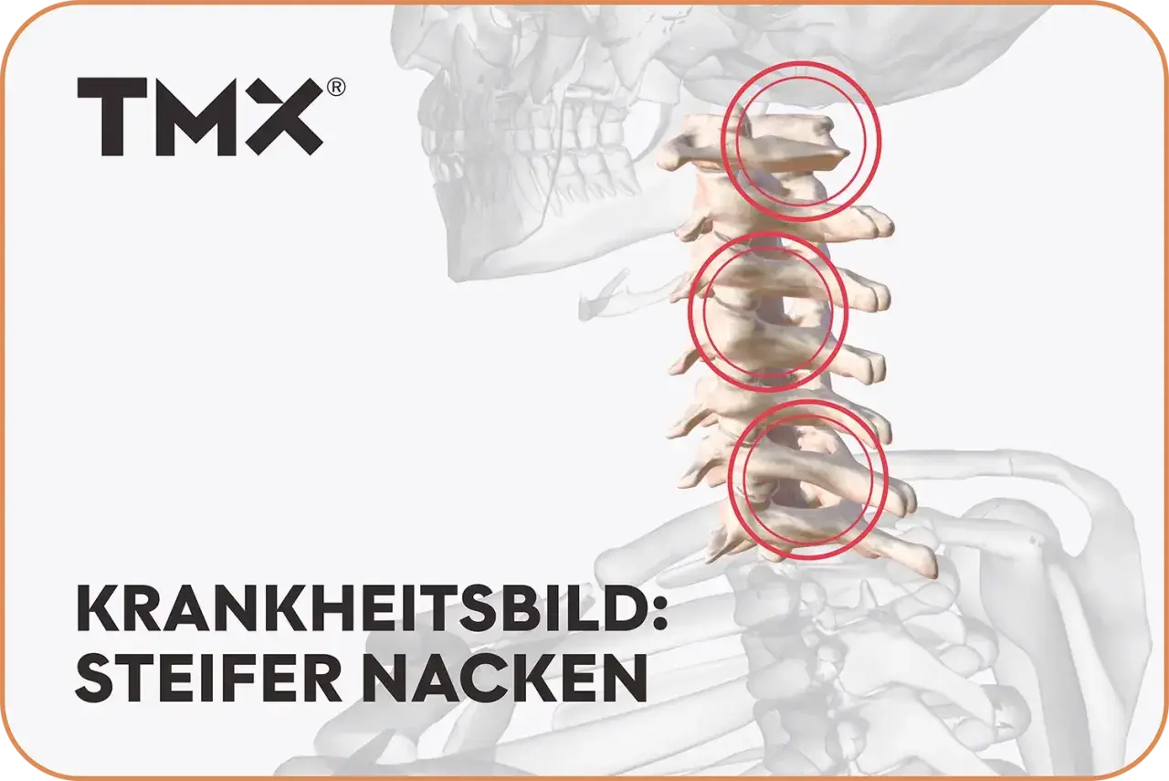 Grafische Darstellung der Halswirbelsäule mit roten Kreisen, die Bereiche markieren, die zu einem steifen Nacken führen können.