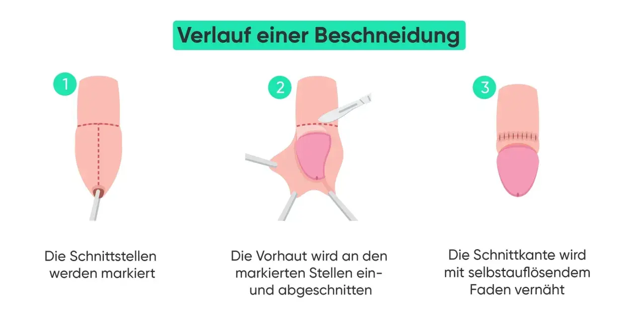 Verlauf einer Beschneidung Mann: Markierung, Schnitt der Vorhaut und Vernähung. Vorher-nachher-Darstellung des Eingriffs.