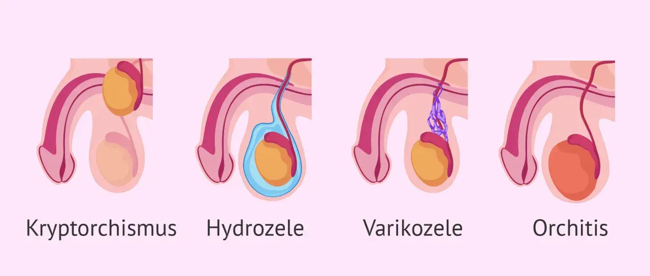 Illustrationen zeigen verschiedene Zustände des Hodens: Kryptorchismus, Hydrozele, Varikozele und Orchitis. Bei manchen Zuständen kann der hoden kleiner geworden sein.