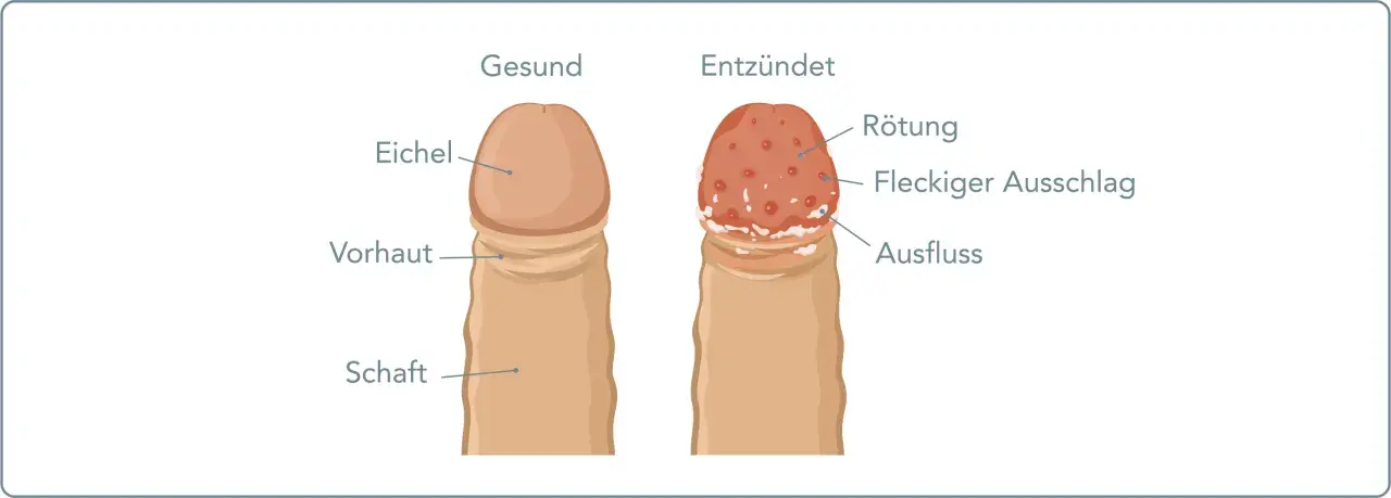 Vergleich: gesunde Eichel vs. entzündete Eichel mit Rötung, Ausschlag und Ausfluss. Bei juckender Eichel können Hausmittel helfen.
