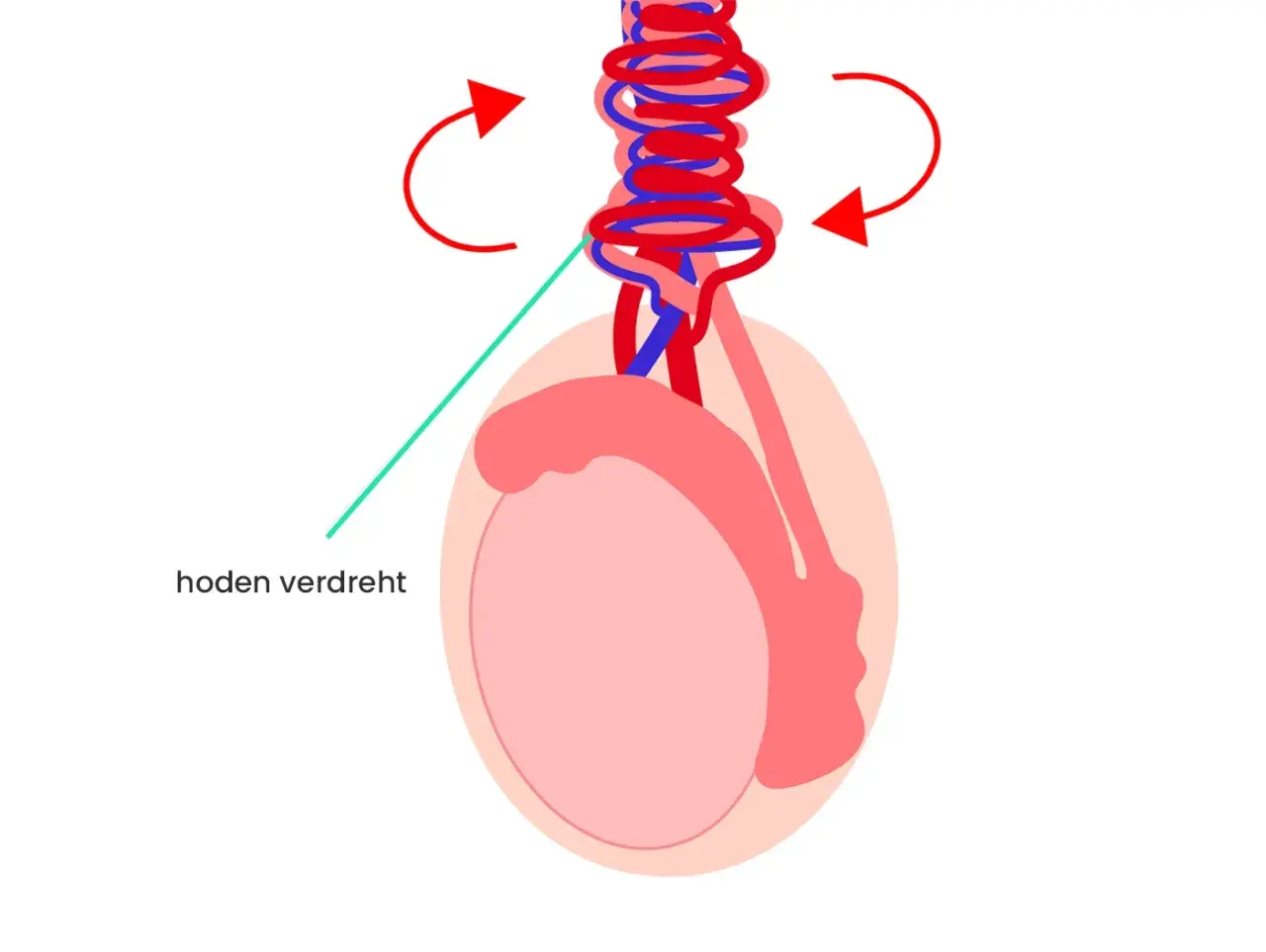 Illustration zeigt einen verdrehten Hoden, der einen Knoten am Hodensack bildet. Rote Pfeile deuten die Drehrichtung an.