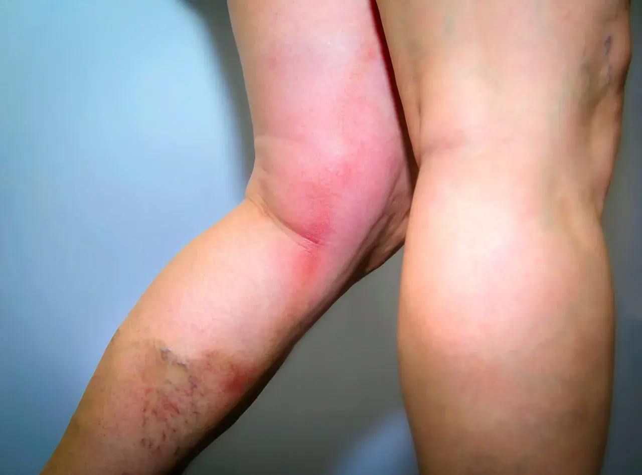 Rotes, geschwollenes Bein mit sichtbaren Krampfadern. Mögliche verstopfte Venen in den Beinen Symptome.
