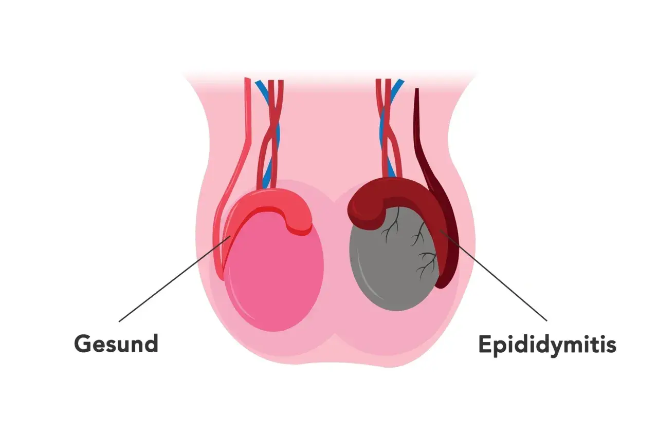 Ein Mann hat zwei Hoden. Dieses Bild zeigt einen gesunden Hoden (rosa) und einen mit Epididymitis (grau).