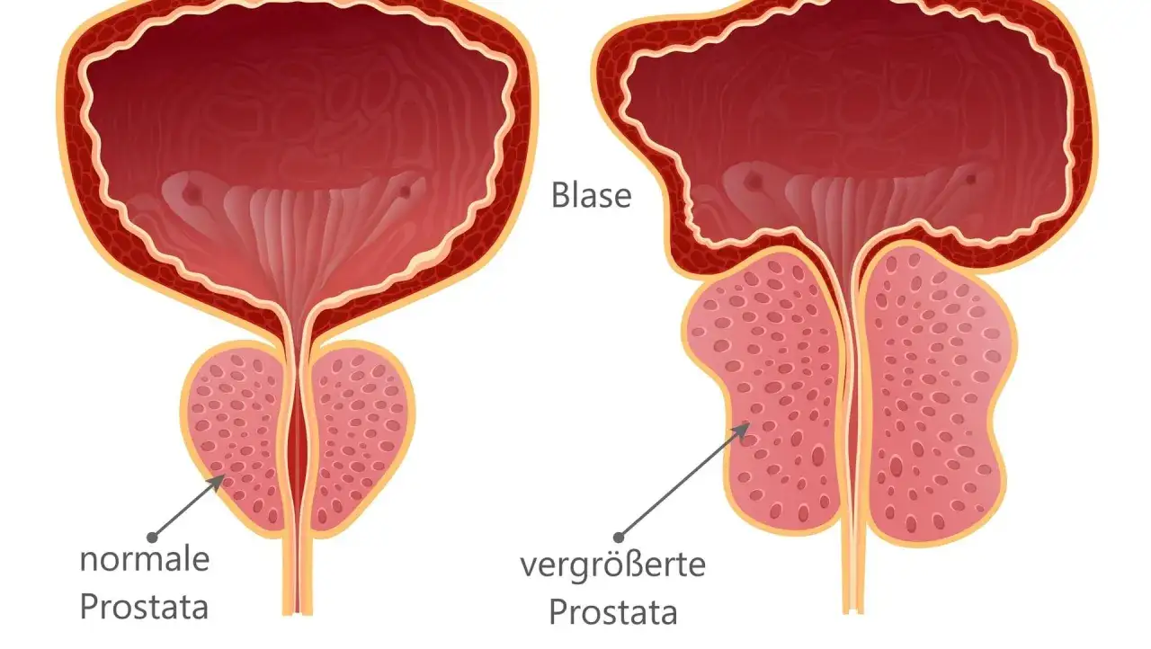 Vergleich von Blase und Prostata: Normale Prostata vs. vergrößerte Prostata. Eine vergrößerte Prostata kann zu Beschwerden wie brennen beim Wasserlassen führen.