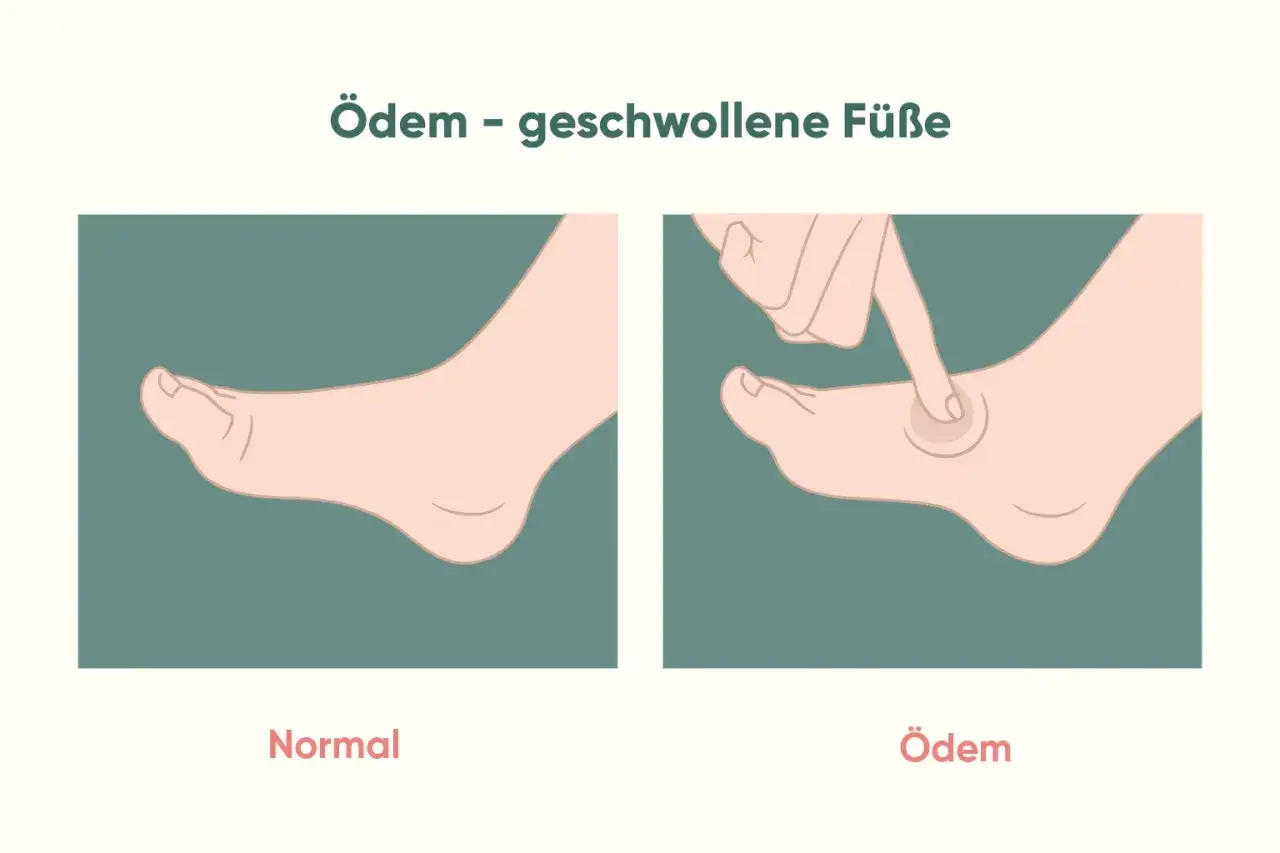Vergleich von normalem Fuß und geschwollenem Fuß (Ödem). Ein Finger drückt auf den geschwollenen Fuß, wodurch eine Delle entsteht. Dicke Beine können ein Zeichen für Ödeme sein.