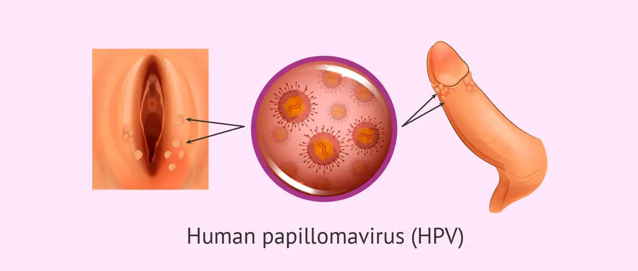 Darstellung von Feigwarzen bei einem Mann, verursacht durch HPV. Die Abbildung zeigt das männliche Genital mit Warzen und eine Vergrößerung des Virus.