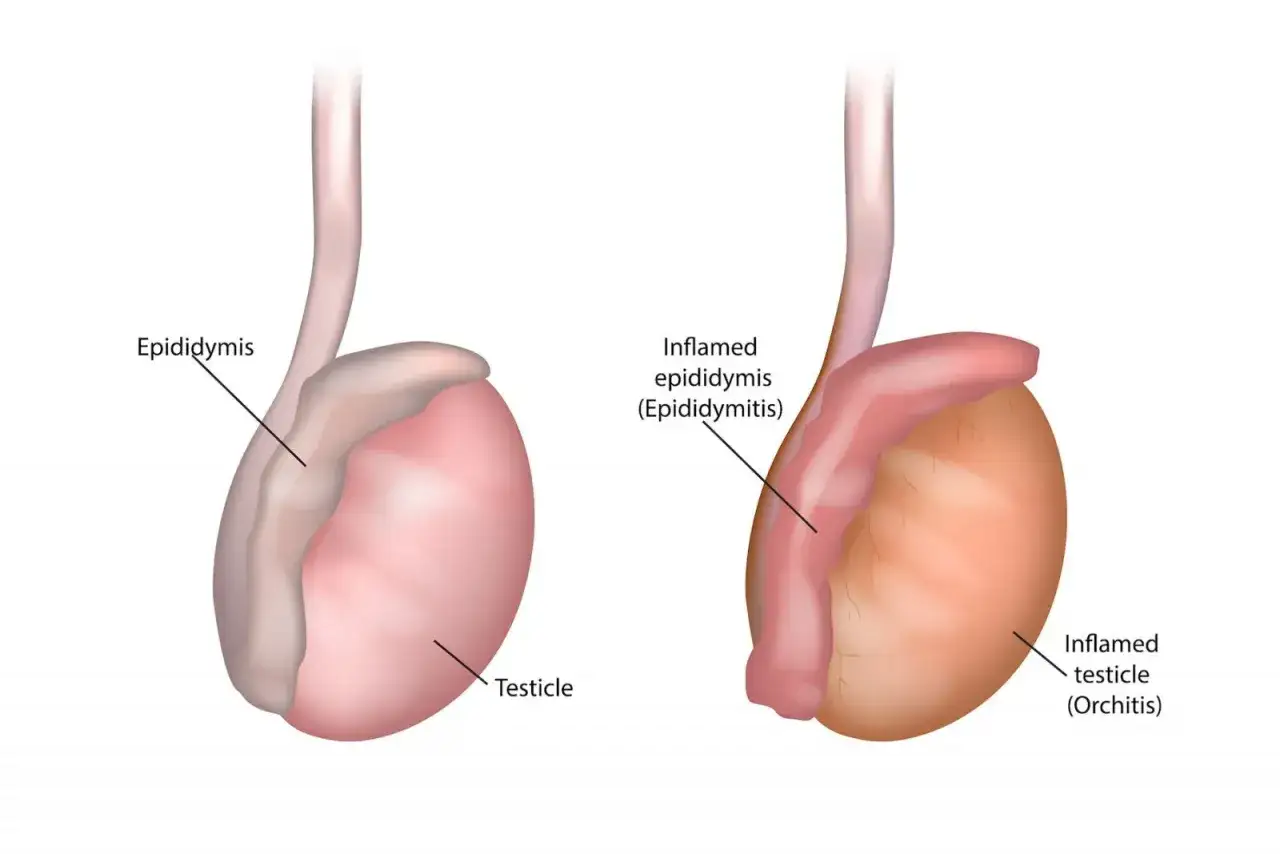 Vergleich: gesunde Hoden vs. entz&uuml;ndete Hoden. Erkl&auml;rt, was sind Kavaliersschmerzen (Epididymitis/Orchitis).